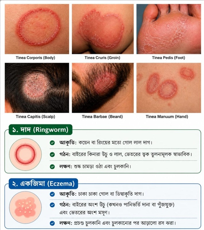 দাউদ ও ফাঙ্গাল সংক্রমণের লক্ষণ ও তথ্য